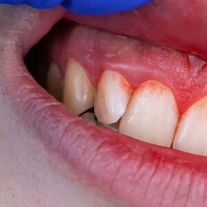 Periodontist explaining gum disease treatment options in Chula Vista, CA.