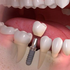 Board-certified periodontist performing dental implant surgery in Chula Vista, CA.
