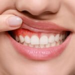 Common gum disease treatment options like LANAP and laser SRP in San Diego and Chula Vista.