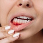 Dental insurance coverage for periodontal treatment and LANAP laser surgery in Chula Vista.