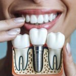 Cost of full mouth dental implants and All-on-4 in Chula Vista, California.