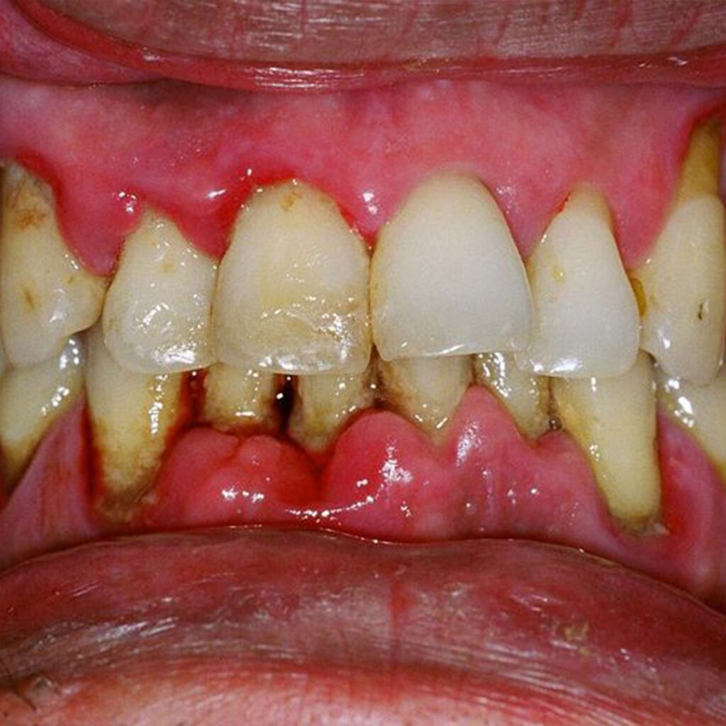 Timeline of tooth loss and bone destruction from periodontitis in Chula Vista, CA.