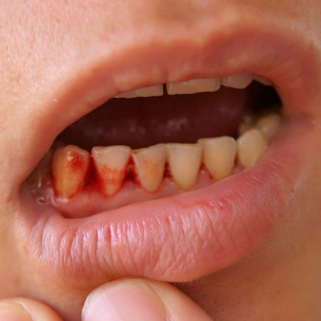 Comparison of LANAP laser surgery and scaling and root planing for gum disease in Chula Vista, CA.