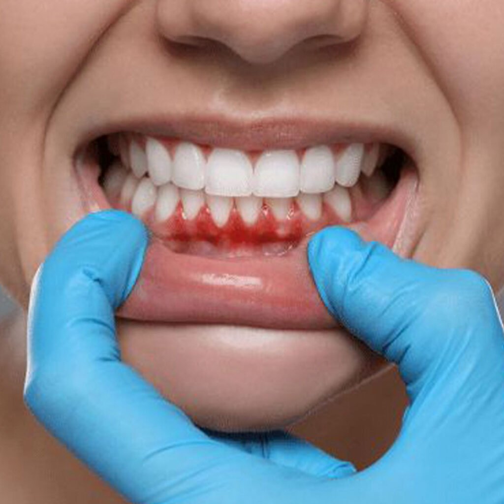 Minimally invasive gum grafting and PRF therapy for receding gums in Chula Vista, CA.