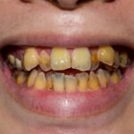 Comparison of reversible gingivitis vs permanent bone loss from periodontitis in Chula Vista.