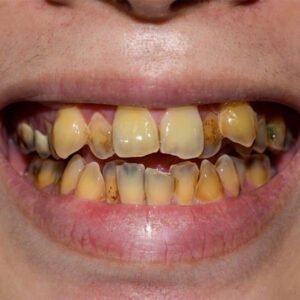 Comparison of reversible gingivitis vs permanent bone loss from periodontitis in Chula Vista.