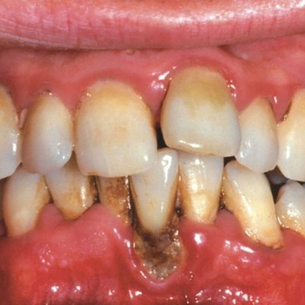 Advanced periodontitis treatment and bone loss prevention in Chula Vista CA.