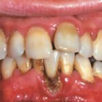 Advanced periodontitis treatment and bone loss prevention in Chula Vista CA.